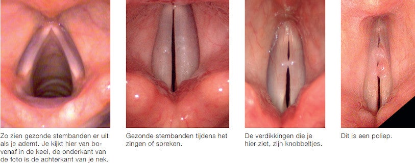 Stemproblemen bij zangers - Hoe deze ontstaan Stemproblemen bij zangers - Hoe deze ontstaan